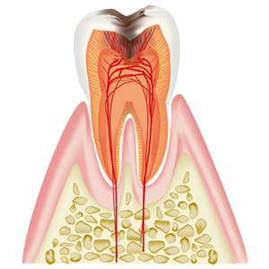 神経 (歯髄)に達したむし歯