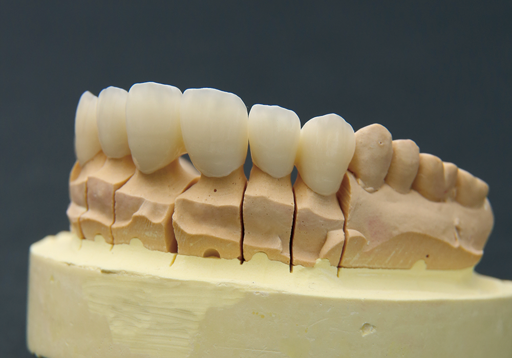 ジルコニアセラミッククラウン