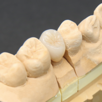 オールセラミック