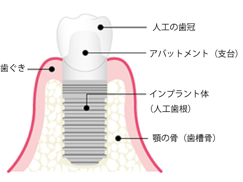 インプラントの構造