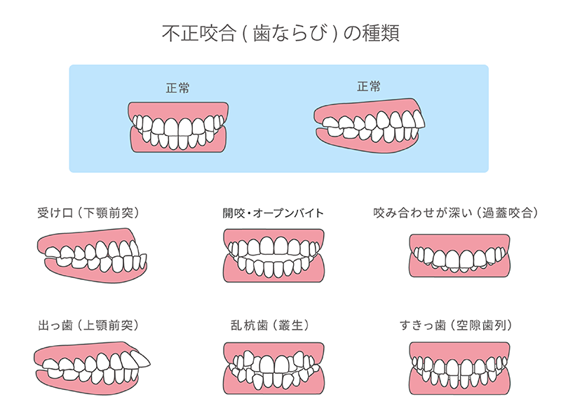 歯ならびの種類