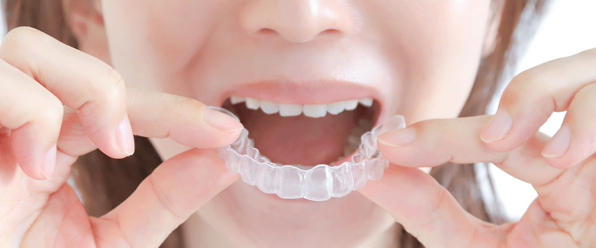マウスピース矯正